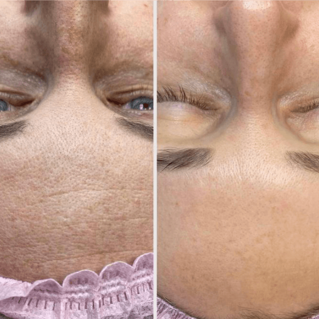 Lite Peel at Luxe Skin Care in Dallas, TX