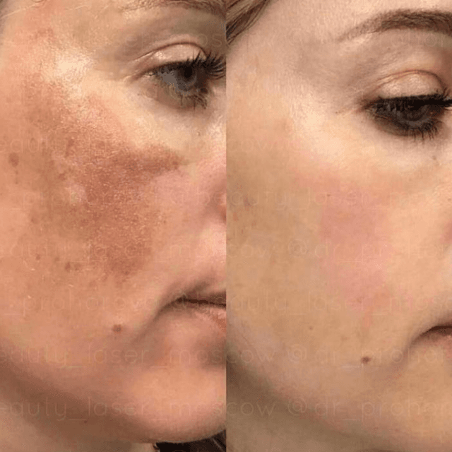 Revitalize Peel at Luxe Skin Care in Dallas, TX